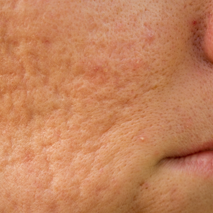 Laser acne